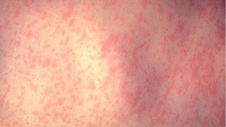Sydney measles alert: Unvaccinated woman and two children infected 