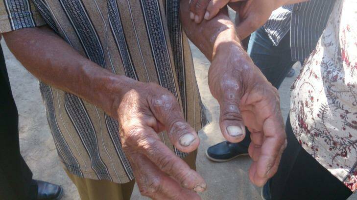 The hands of a local resident in Tablolong in August, 2013. People in the region complain of itchy skin conditions, possibly connected to the spill. Photo: Australian Lawyers Alliance